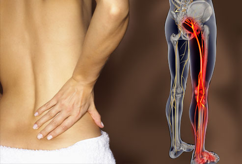 webmd_rm_photo_of_lower_back_pain (1)