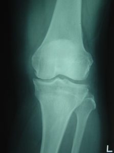 変形性膝関節症のレントゲン写真